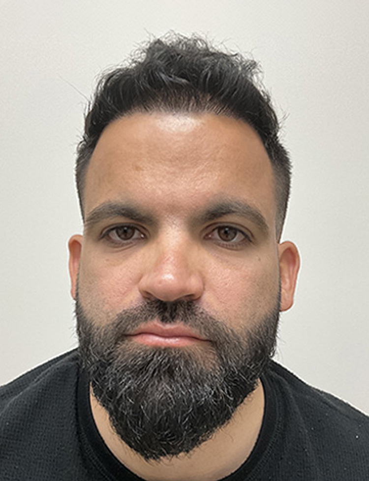 Transplante capilar NeoGraft em Miami depois