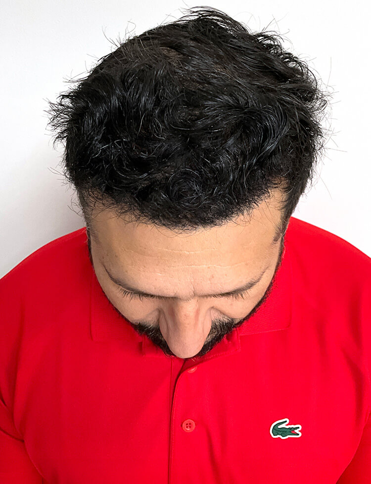 hair transplant Miami after