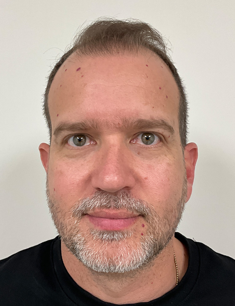 hair restoration before and after