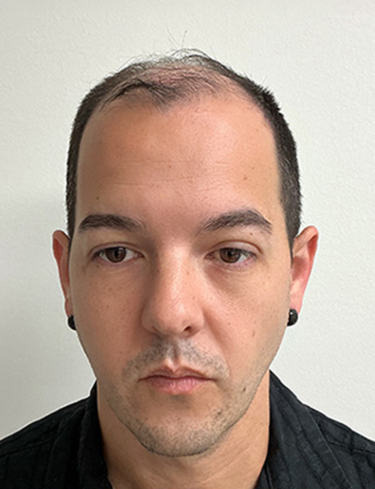 Transplante Capilar FUE em Miami foto do antes