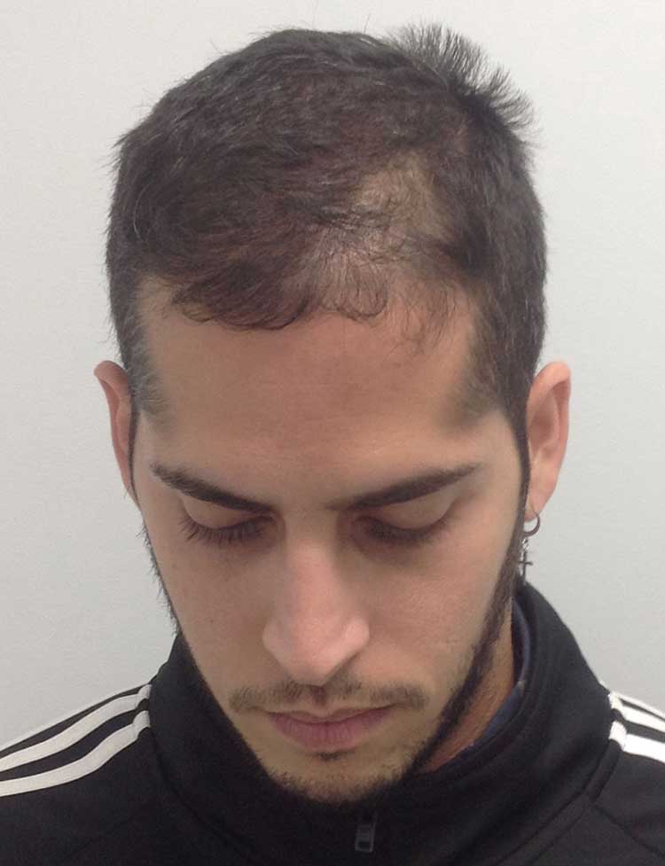 hair transplant before