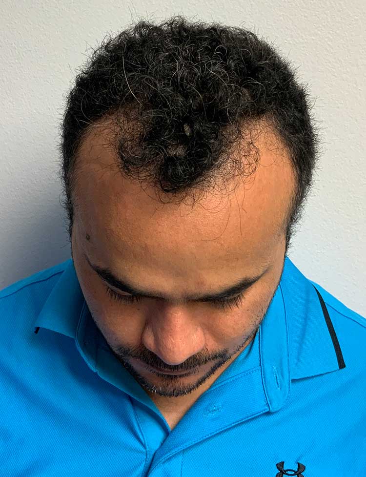 hairline restoration 2000 grafts before