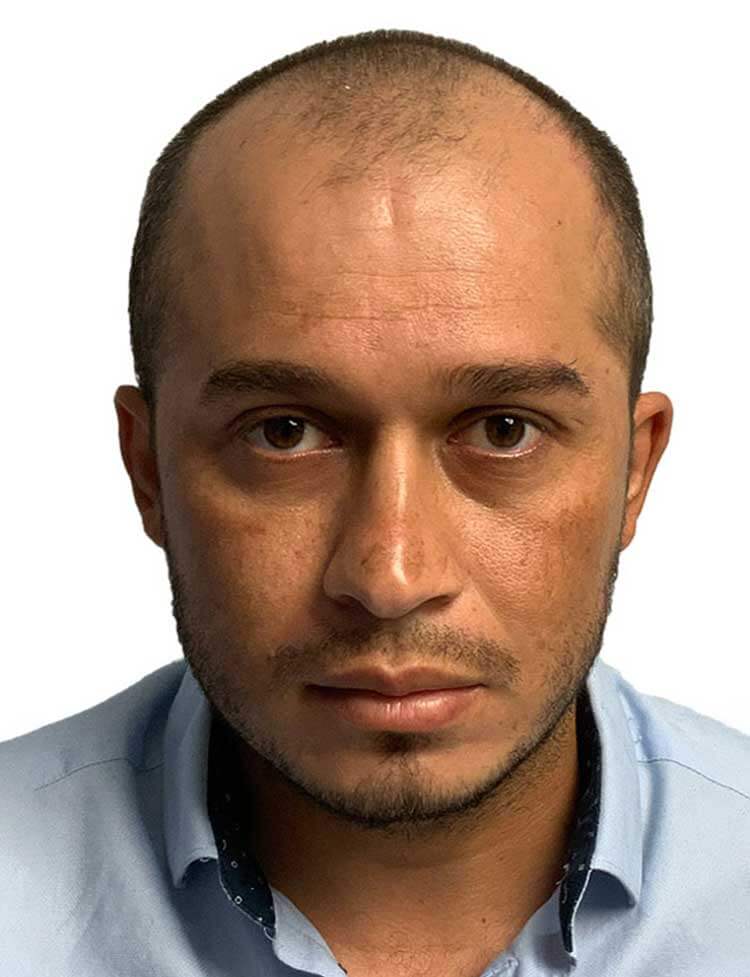 Trasplante de pelo Étnico en Miami antes