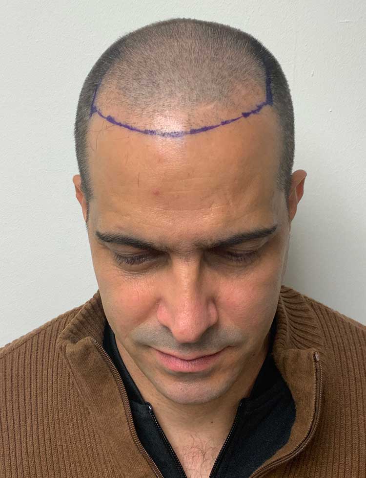 hairline restoration before photo