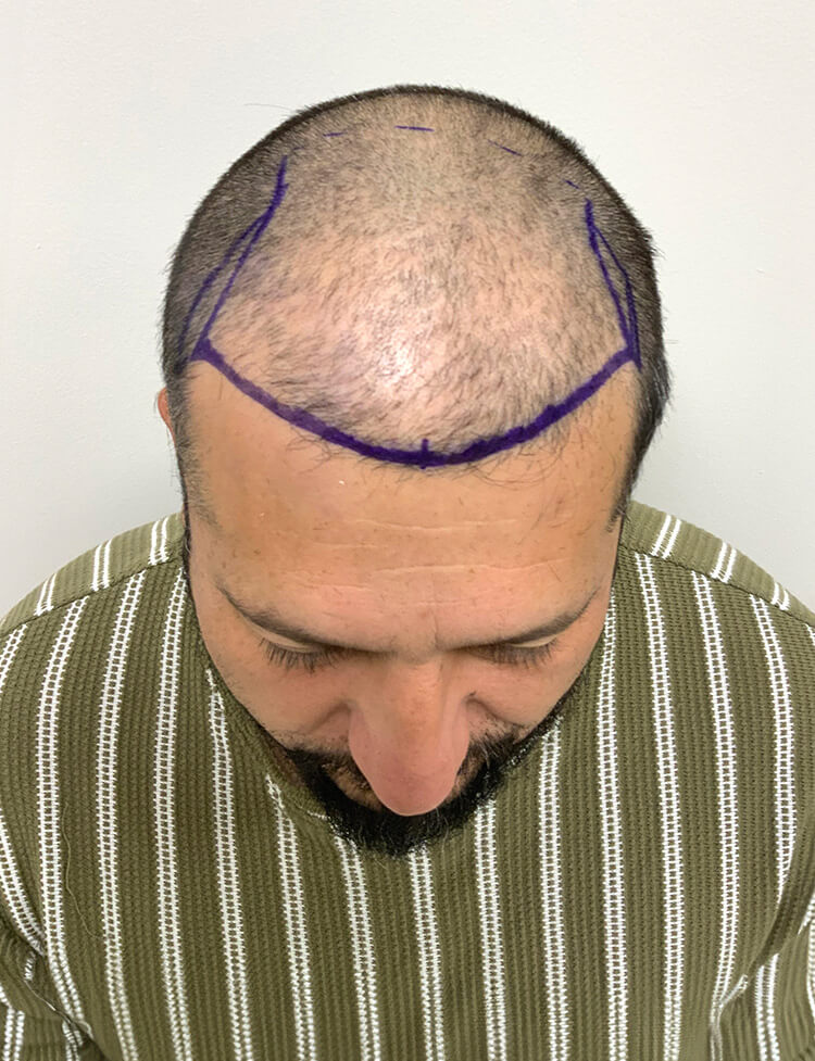 hair transplant Miami before