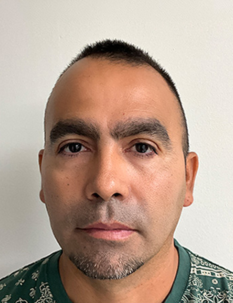Restauração da linha capilar com NeoGraft antes