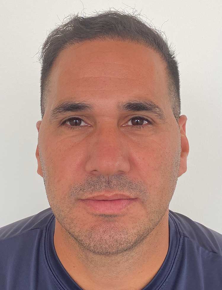 FUE hair transplant after