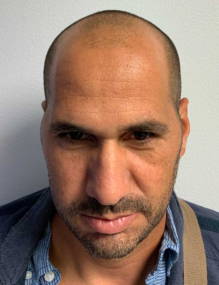 FUE hair transplant before