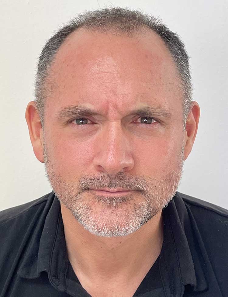 hairline restoration 1800 grafts before photo