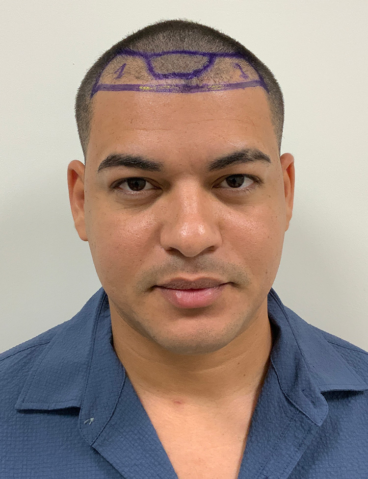 hair transplant before and after