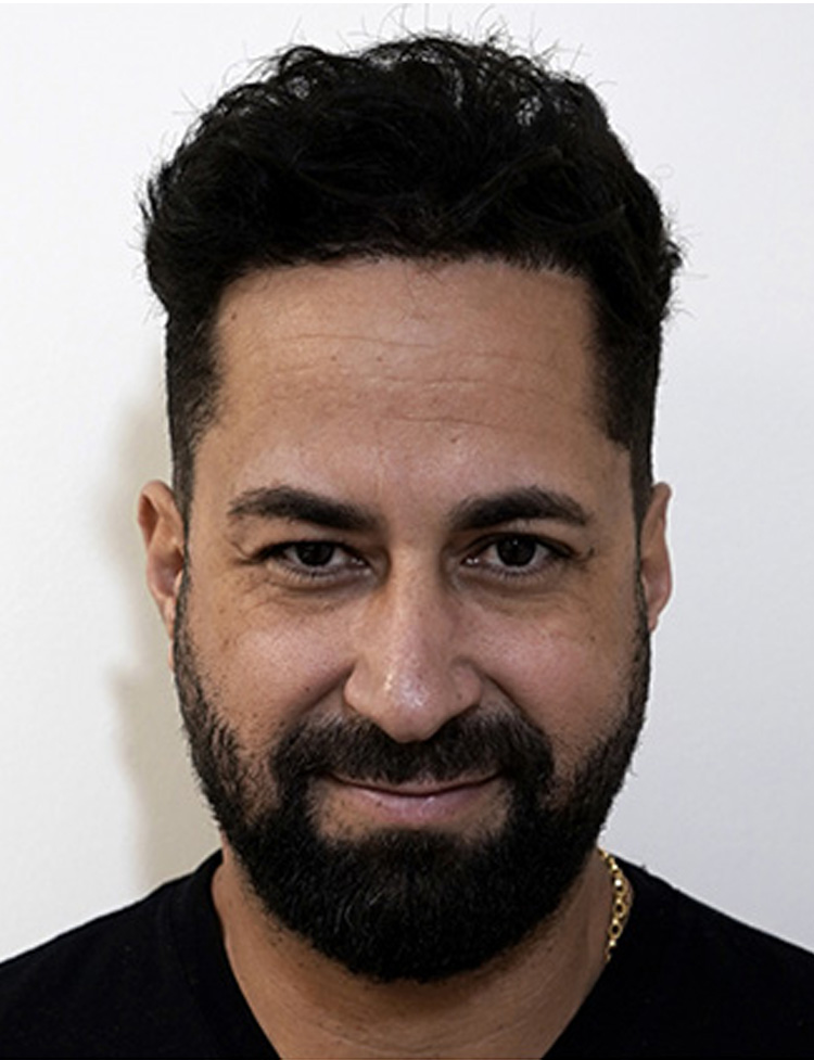 Restauração da linha frontal com Neograft depois