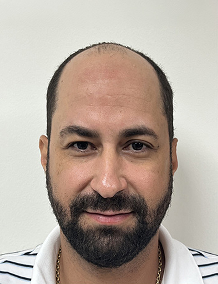 Restauração da linha frontal com Neograft antes
