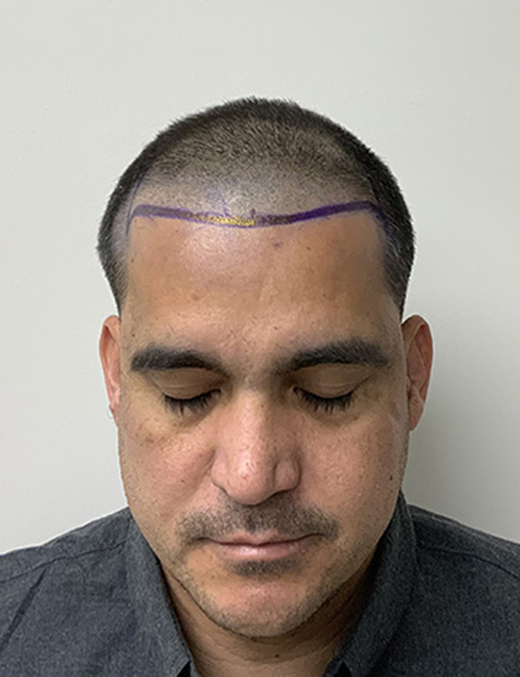 Foto de paciente antes do transplante capilar