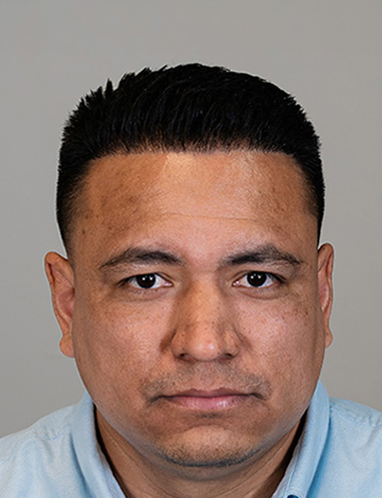 Transplante capilar masculino com NeoGraft depois