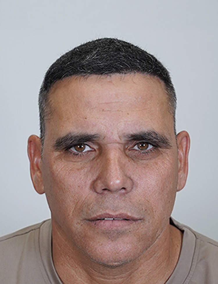 Transplante capilar masculino depois