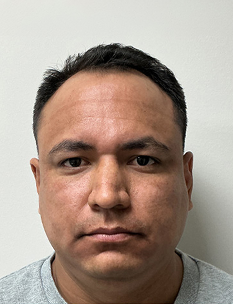Transplante capilar masculino com NeoGraft antes