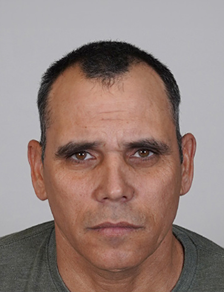 Transplante capilar masculino antes