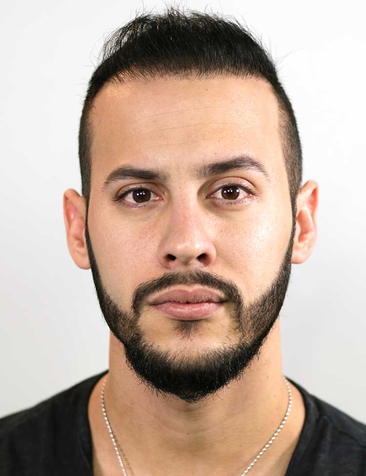 neograft hair restoration after photo