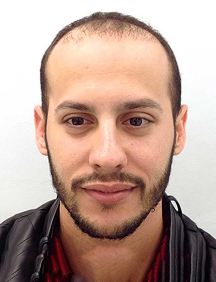 neograft hair restoration before photo