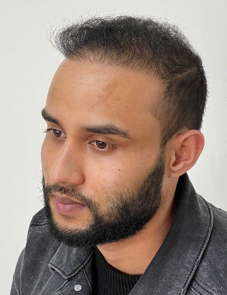 FUE hair transplant 2500 grafts after photo