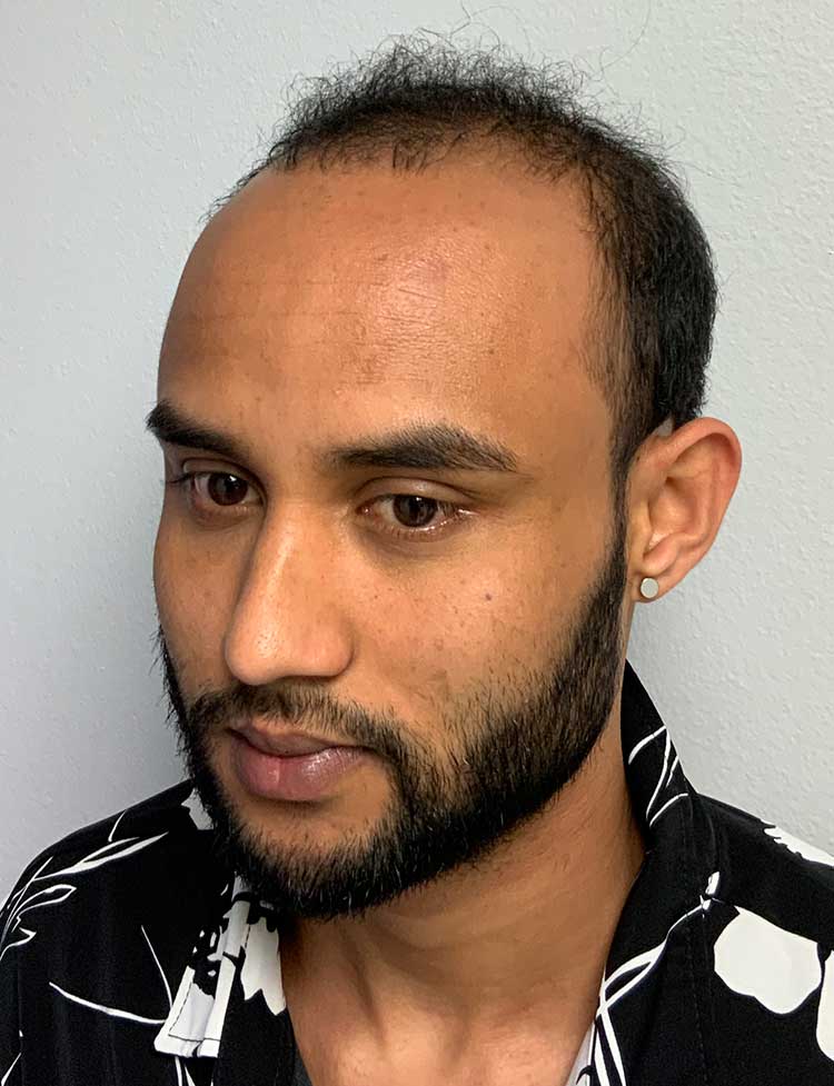FUE hair transplant 2500 grafts before photo