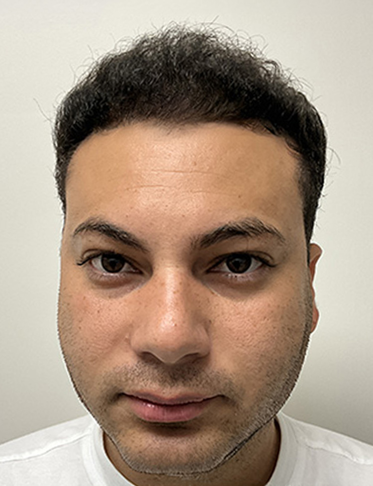 hair restoration 42 years old patient after photo