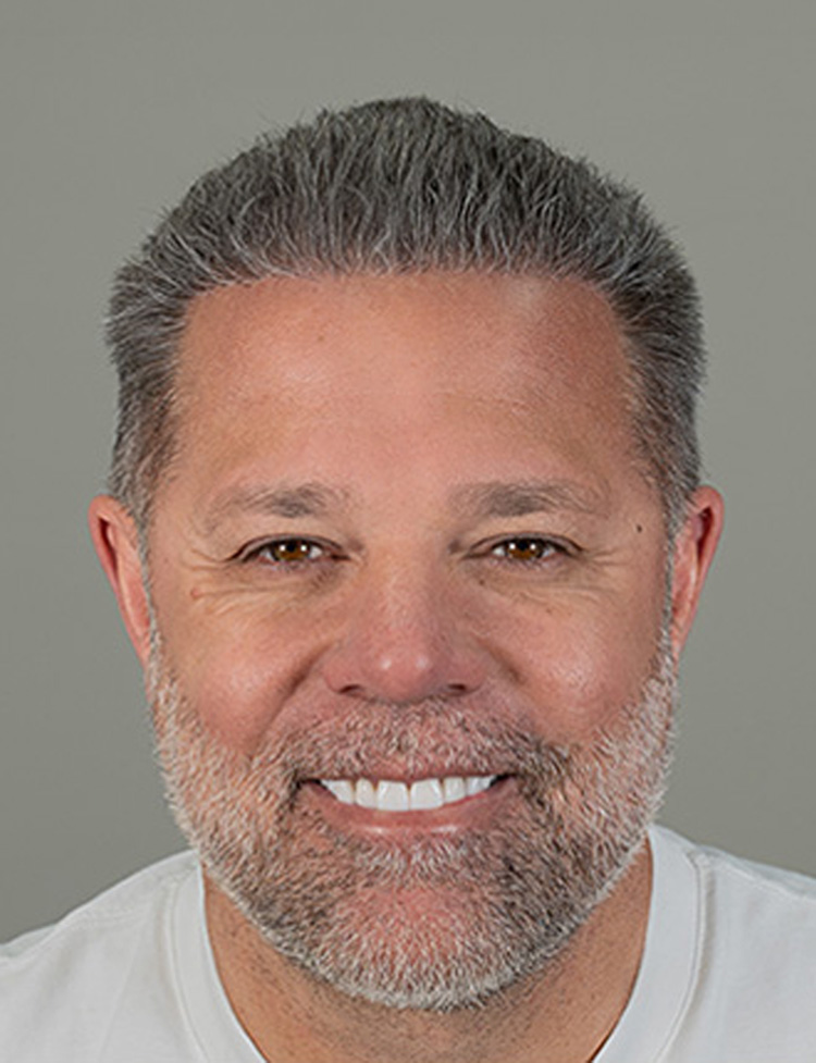 hair transplant after