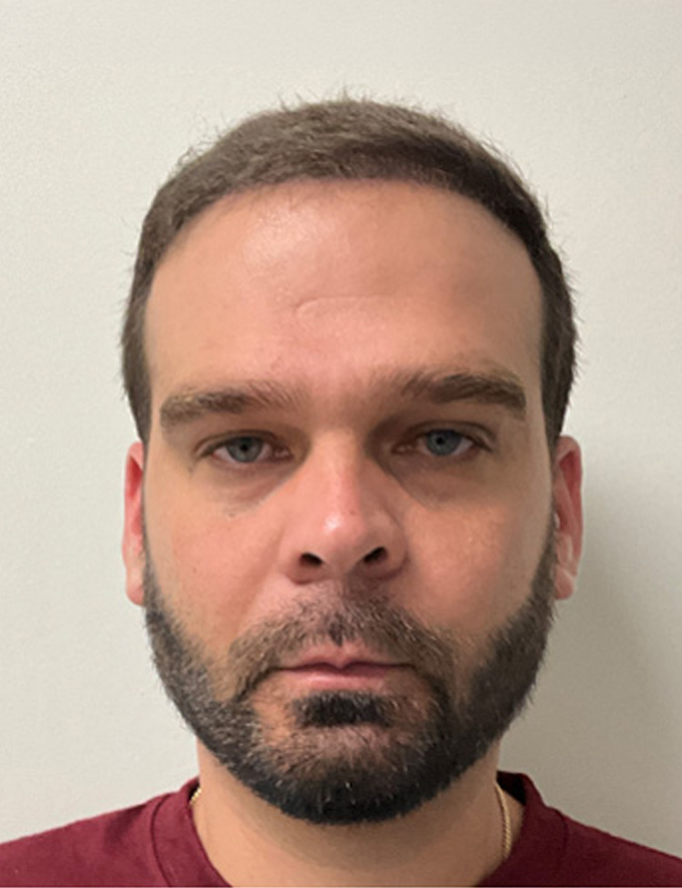 robotic hair transplant miami after photo
