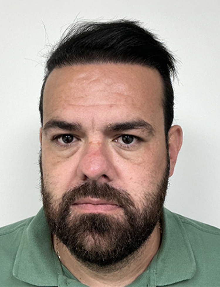 automated fue hair restoration after