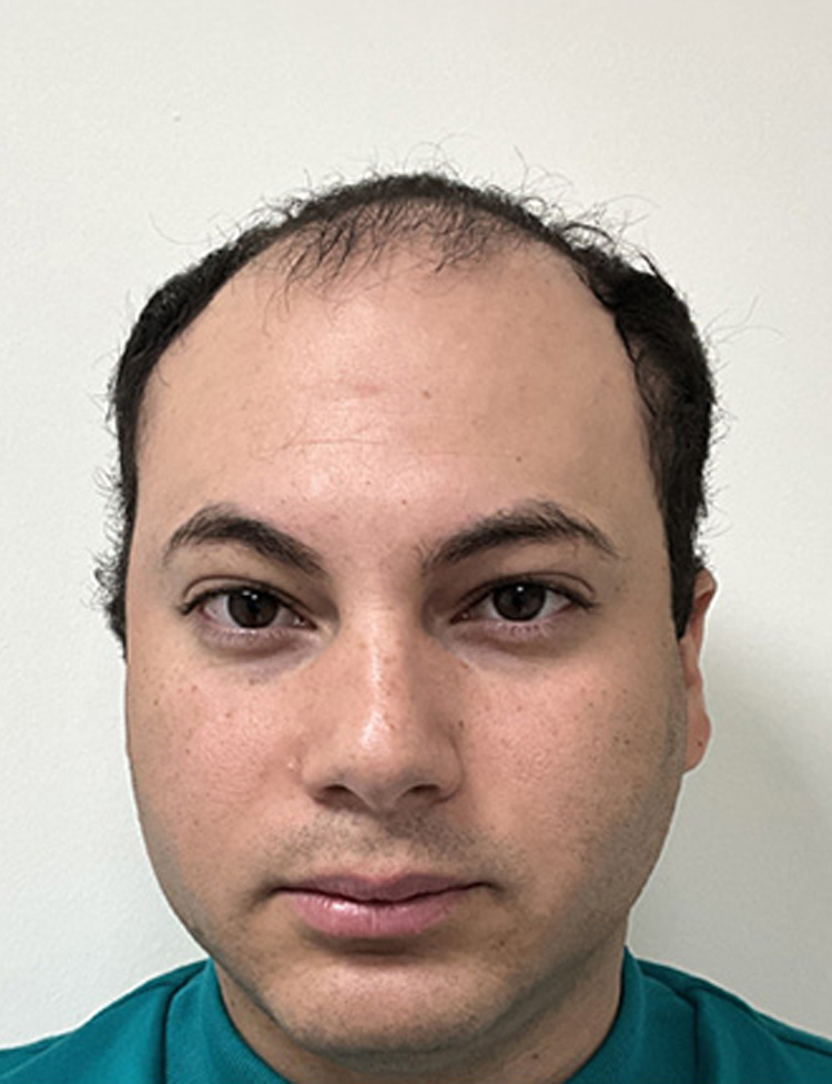 hair restoration 42 years old patient before photo