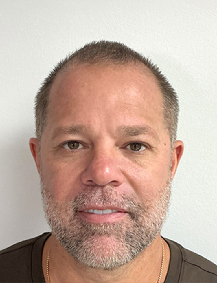 hair transplant before