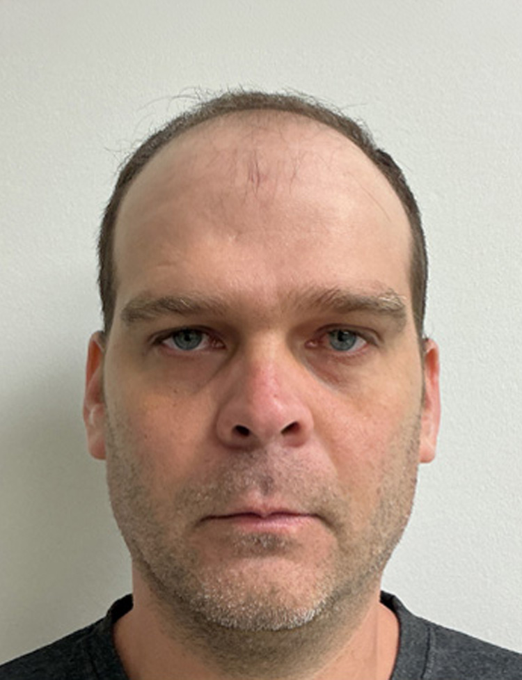 robotic hair transplant miami before photo