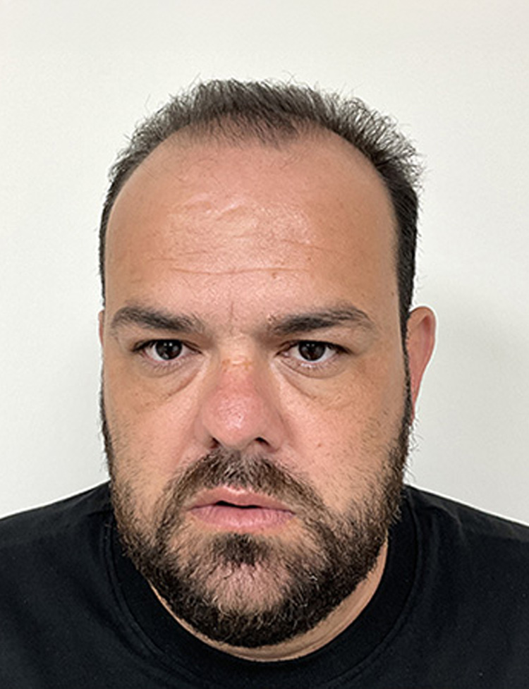 automated fue hair restoration before