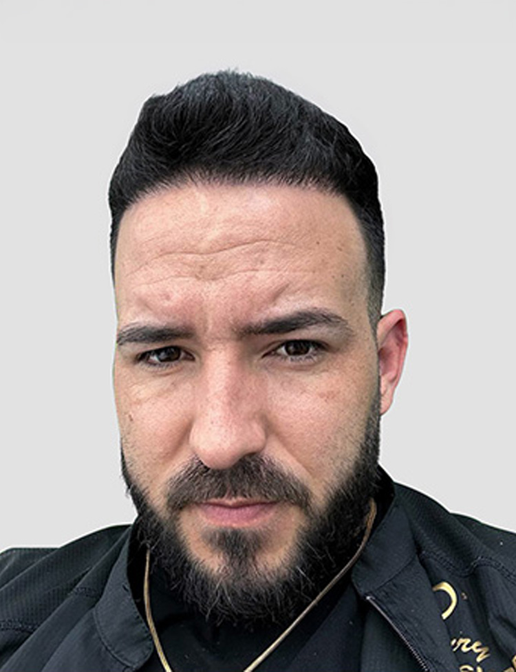 Foto do depois da restauração capilar com técnica FUE de safira
