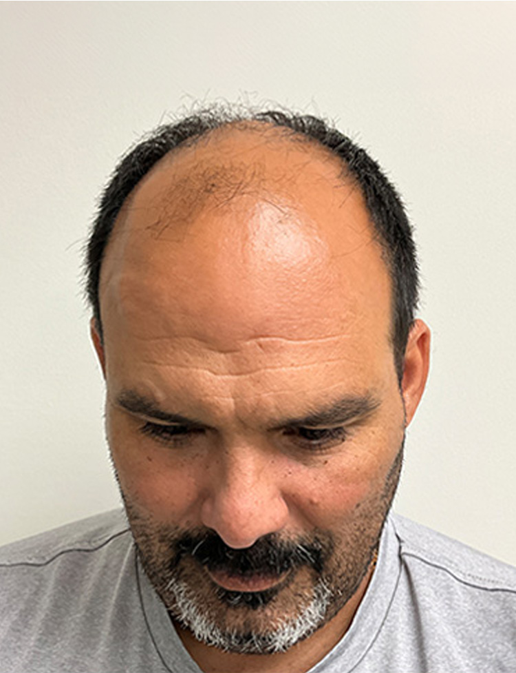 Restauração da linha capilar com NeoGraft antes
