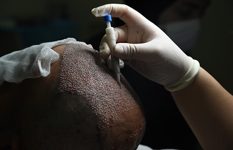 Is Hair Transplantation Painful?