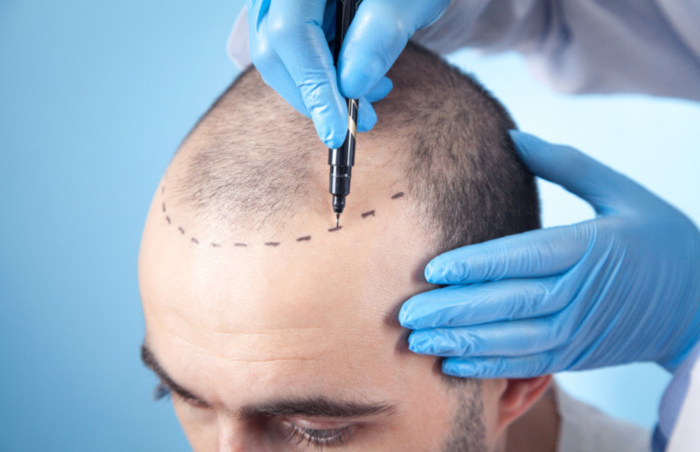 Descubre Cuál es la Mejor Edad para el Trasplante de Cabello
