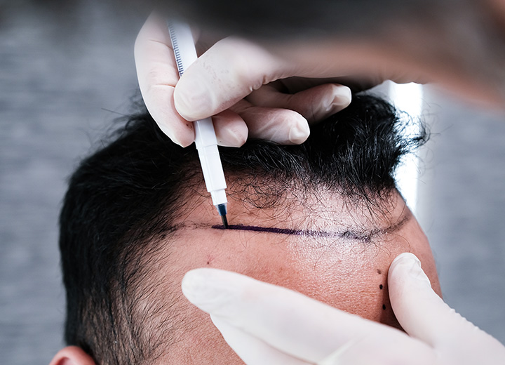 No Shave Hair Transplant