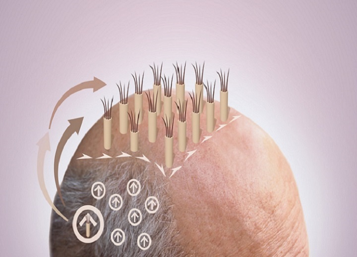 What is Robotic Hair Restoration
