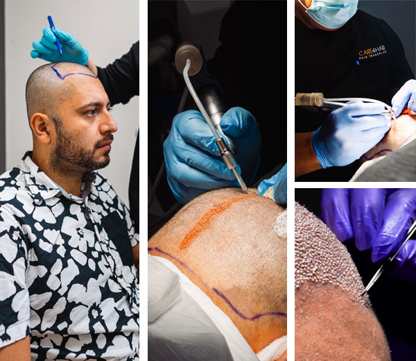 fases del trasplante capilar en la clinica