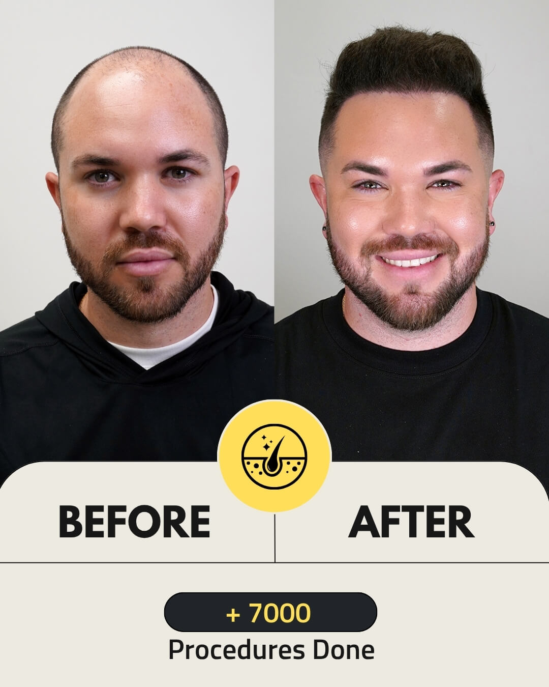 4500 folicles hair transplant patient