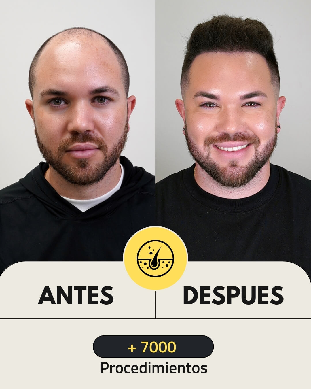 4500 folicles hair transplant patient