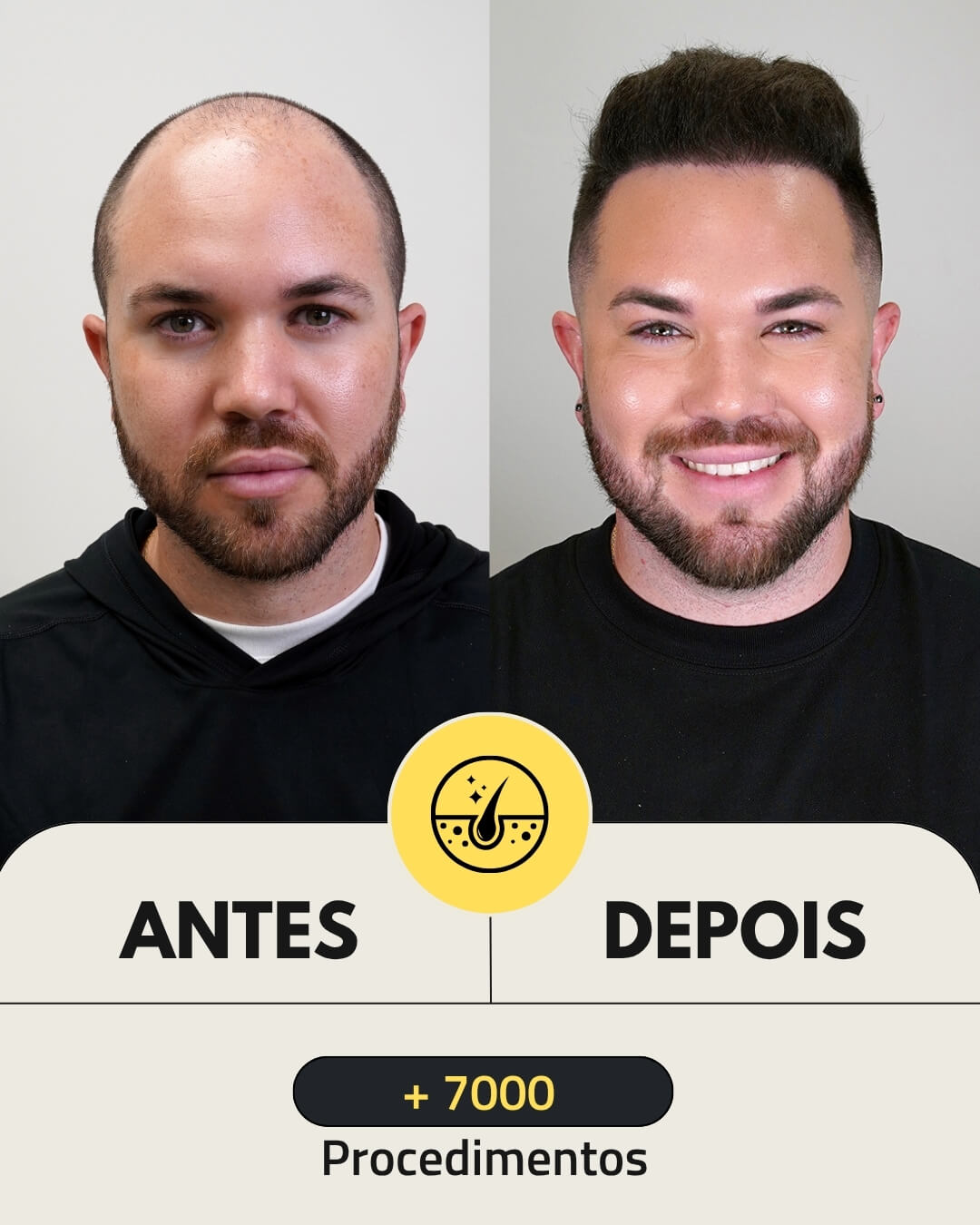 4500 folicles hair transplant patient