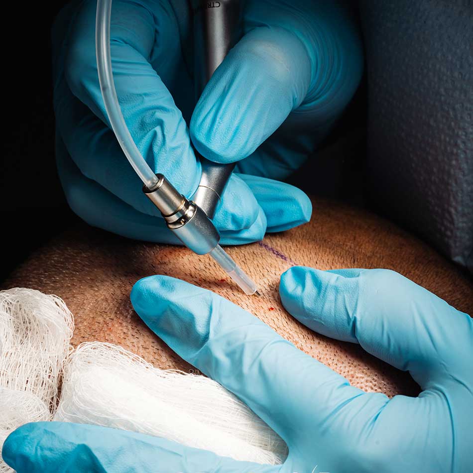 fue hair transplant in-miami neograft technique