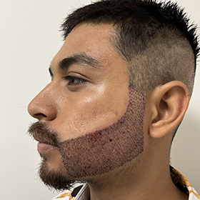 jorge día después de su reconstrucción de barba