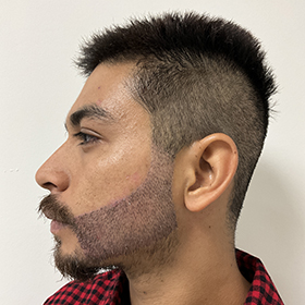 jorge 1 semana después de su reconstrucción de barba
