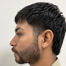 jorge 3 meses después de su reconstrucción de barba