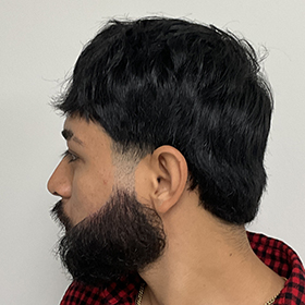 jorge 8 meses después de su reconstrucción de barba