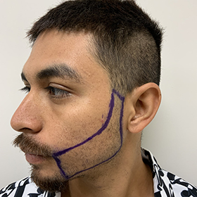 jorge el dia de su reconstrucción de barba