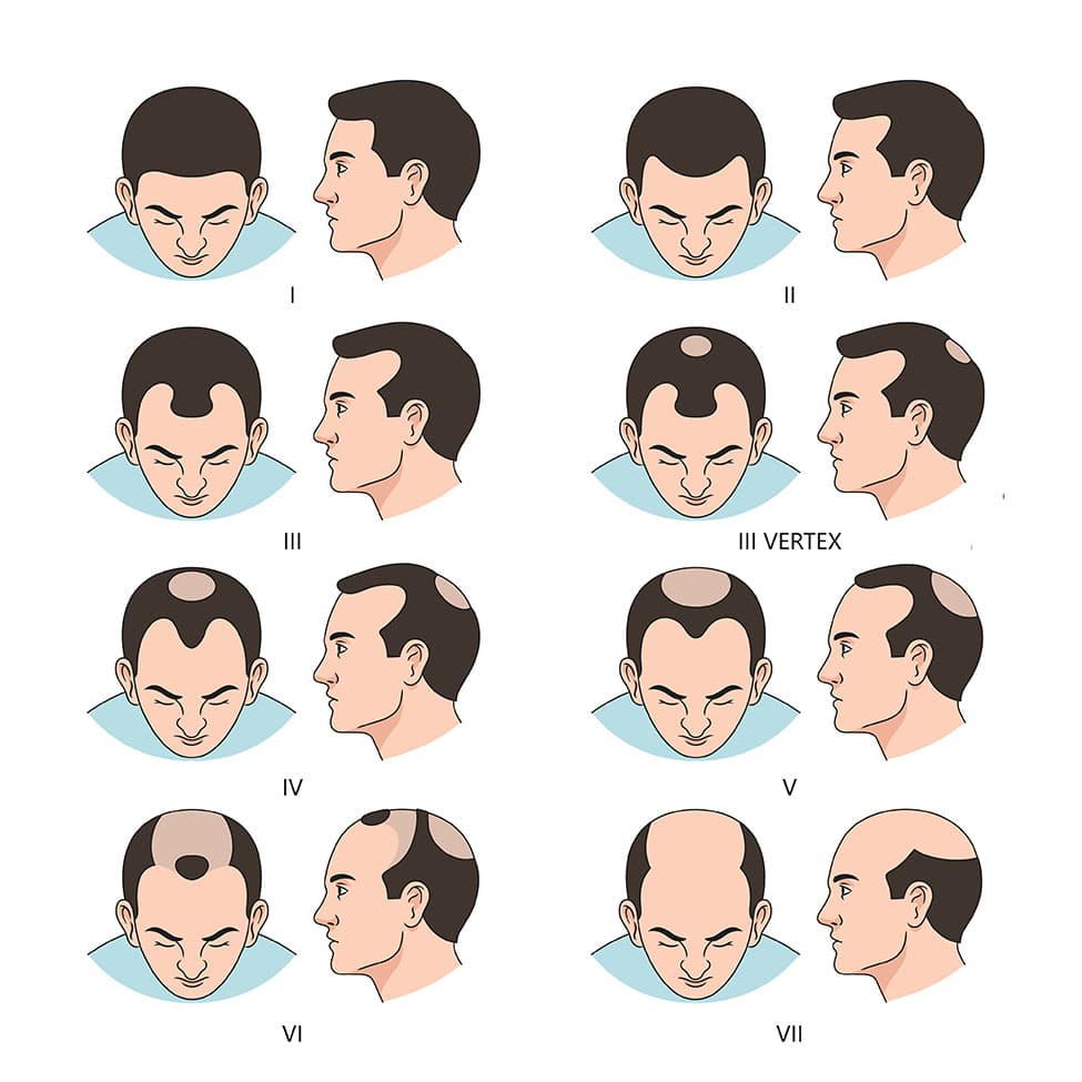 the Norwood Scale